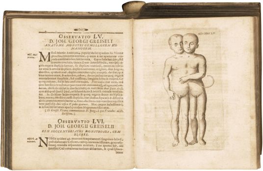Johann Georgius Greiselius,&nbsp;De anatome monstri gemellorum humanorum
